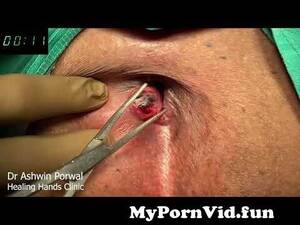 anal thrombosis - Fastest Laser Surgery For Bleeding Hemorrhoids with External Thrombosis in  3Mins by Dr Ashwin Porwal from anal mandi do Watch Video - MyPornVid.fun