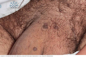Baby Born With Warts On Anal Area - Male genital warts