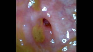 Colonoscopy Porn - Colonoscopy Porn Videos - Xvideos