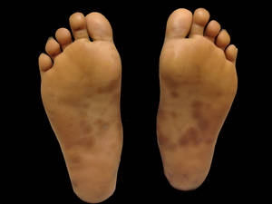 Madagascar Porn Barefoot - Facial flushing with penicillin