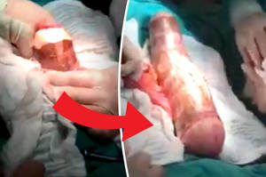 homemade rectal toys - WATCH: 18ins homemade sex toy surgically removed from man's anus | Daily  Star