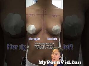 naked indian babes nipples tiny breast implants - Breast Augmentation- A to a C Cup Before and After!  #breastaugmentationsurgery from indian girl boobsjob imageengland  videovijayashanthix 3gp download only mmswww Watch Video - MyPornVid.fun