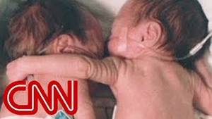 Attack On Titan Slave Porn - The hug that helped change medicine