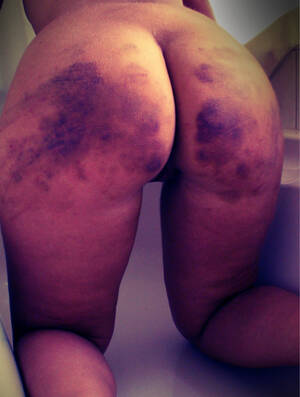 bruised ass from spanking - Bruises after spanking | MOTHERLESS.COM â„¢