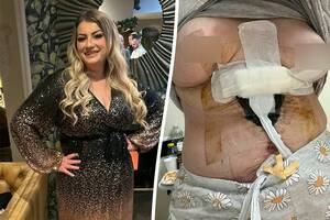 fat wife passed out sex - South Wales woman needed eight life-saving operations after Turkey tummy  tuck | The Independent
