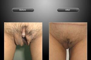 before and after nude transexual - Transsexual Surgery Before After - XXGASM