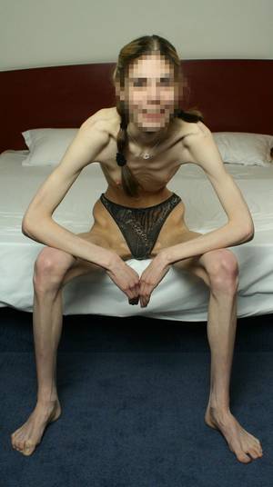 almost anorexic - Anorexic girl