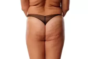 flat fat butt girl anal - fat ass woman with cellulite Stock Photo | Adobe Stock