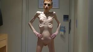 Anorexic Hd - Anorexia Christin showing her Bones & Skinny Skeleton