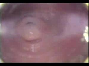 internal anal camera - 