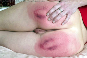 bruised after spankings - teen girl bruised bottom