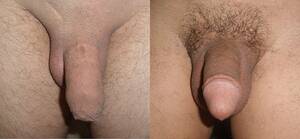 Circumcised Vagina Porn - Circumcised Vagina Before And After