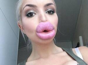 Duck Lips Porn - Enormous 'porn star lips' on show in terrifying gallery of selfies