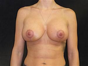 Breast Lift Porn - Breast Augmentation With Breast Lift | Andrew Lofman, MD, FACS