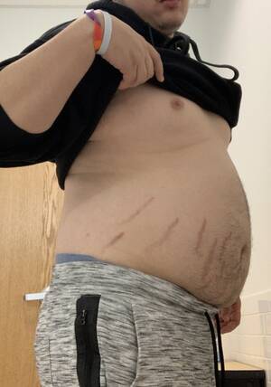 fat teen stretch marks - The Fat Boy Diet â€” Can't control myself anymore.. belly has taken...