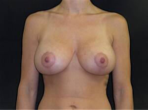Breast Lift Porn - Breast Augmentation With Breast Lift | Andrew Lofman, MD, FACS