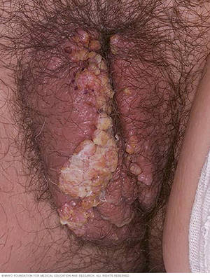 Baby Born With Warts On Anal Area - Female genital warts