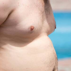 fat swollen tits - Gynecomastia vs. Chest Fat: What Are the Causes and How Do I Treat Each?