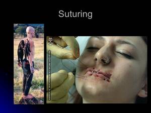 Extreme Body Modification Bdsm Porn - Suturing; 86.