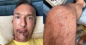 Disease Porn - Gay porn star shares 'brutal' monkeypox experience