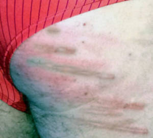 caning her ass crack - Here is a quick pic I took of the lower part of his right butt cheek after  his panties were pulled back up. Pretty!