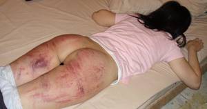 extreme spanking bruise - The Spanking Blog - Spanking News, Spanking Reviews and Spanking Articles.  True accounts of corporal punishment.