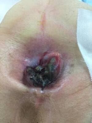 cancer from anal sex - Anal Cancer Clinical Presentation: History, Physical Examination