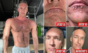 Nose Bump Porn - Gay porn star Silver Steele posts horrific photos of monkeypox battle |  Daily Mail Online