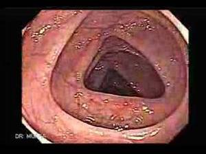 internal anal camera - Internal Anus Camera