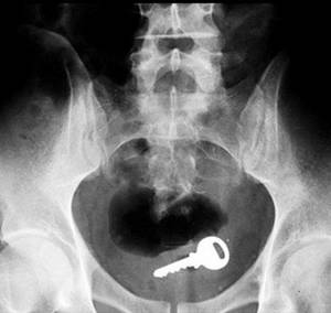 Deep Anal Sex X Ray - 10 Craziest Foreign Objects Found Stuck In A Rectum - found objects. X Ray  ...