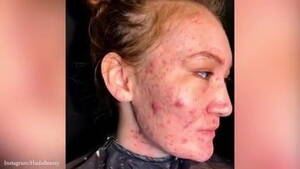 Acne Girl Porn - Women with very bad acne | xHamster