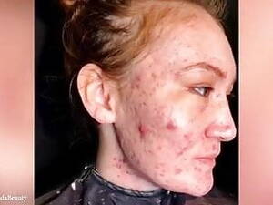 Acne Porn - Women with very bad acne | xHamster