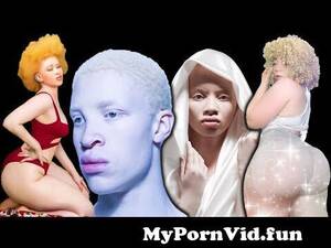 Nude Albino Girl Porn - The Beautiful WHITE'BLACK' Africans. from albino girl nude Watch Video -  MyPornVid.fun