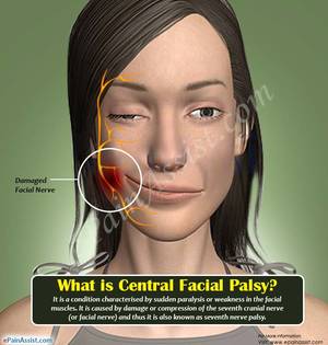 Nerve Porn - Facial Nerve Disorder