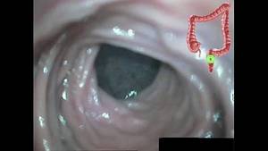 anal intestine - 