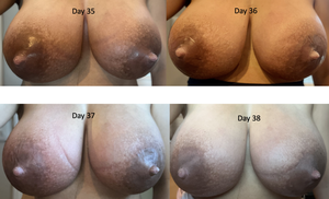 engorged lactating breasts porn pictures - Mastitis, Engorgement, and Breast Complications (with Images)