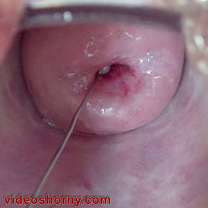 Cervix Fuck Porn - ... Prolapsed cervix with sex toy inserted into her uterus ...