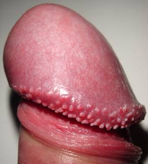 average white cock - Pearly penile papules, a common anatomical variation, may be the vestigial  remnants of penis spines