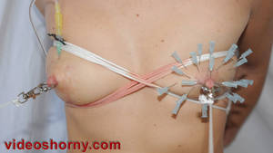 needle injection - Tortured breast with injection of saline with syringe and inflation for  infusion with catheter ...