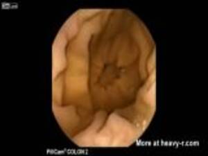 colon cam - Journey Through The Colon