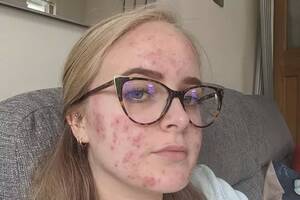 Acne Girl Porn - Woman flaunts acne to show why we should never say our skin is 'bad' -  Daily Star