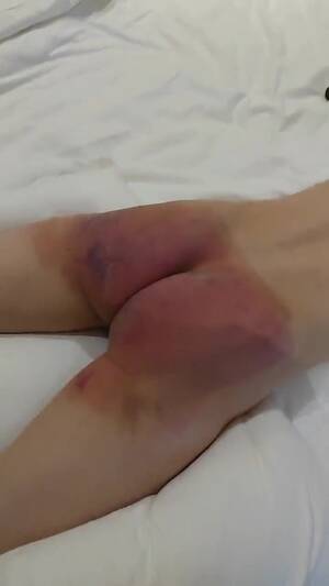 extreme spanking bruise - Spanking: Bruised butt takes more brutalâ€¦ ThisVid.com