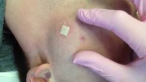 Acne Porn - Pimple Porn Part II - YouTube