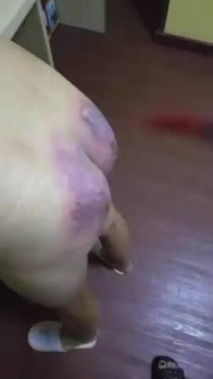 extreme spanking bruise - Severe spanking: Butt bruising punishment - ThisVid.com
