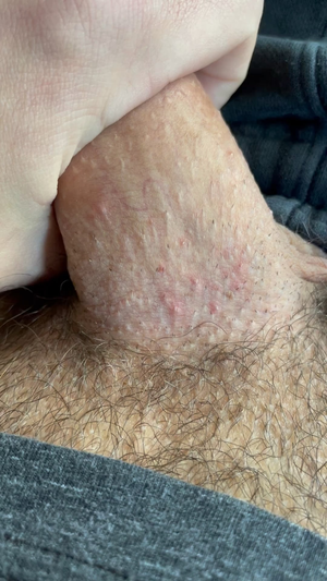 hairy cock shaft - NSFW Penis Warning - I get hair going halfway up, so shaving is necessary,  but I get these ingrown hairs that hurt like crazy : r/popping