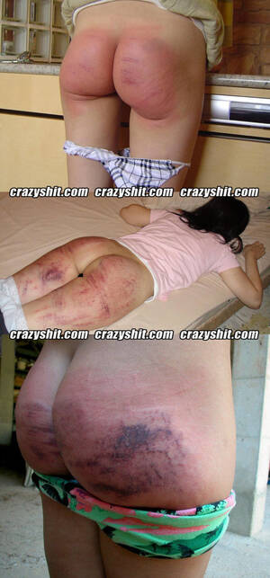 bruised ass from spanking - CrazyShit.com | Spank That Ass Til It's Black and Blue - Crazy Shit