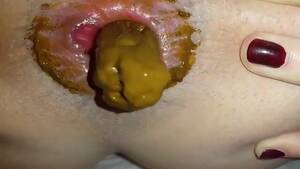 Anal Bleeding Porn - Anal prolapse while pooping and bloody pussy - ThisVid.com