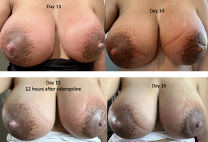 extreme leaking tits - Mastitis, Engorgement, and Breast Complications (with Images)