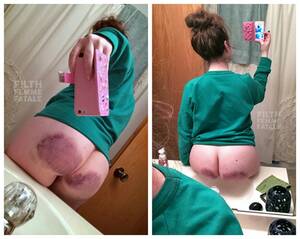 extreme spanking bruise - Paddle Bruise Selfies - Spanking Blog