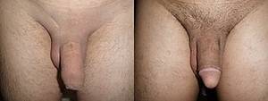 Circumcised Vagina Female Circumcision Porn - Before and after circumcision, in this case done to treat phimosis